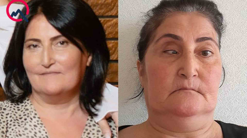 “Liman” klinikasinda şok olay: qadın əməliyyatdan gözü çəp çıxdı