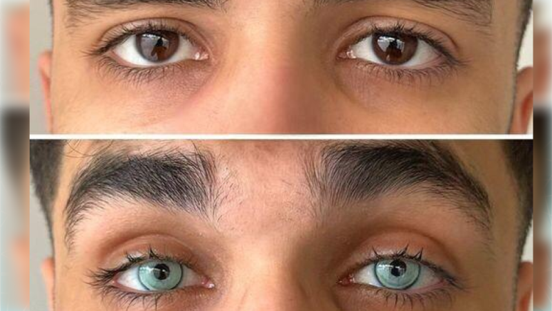 Oftalmoloq: “Göz rəngini dəyişən pasiyent hər şeyi həmin rəngdə görəcək” – AÇIQLAMA