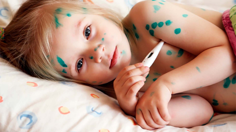 Məktəblilər arasında suçiçəyi yayılıb