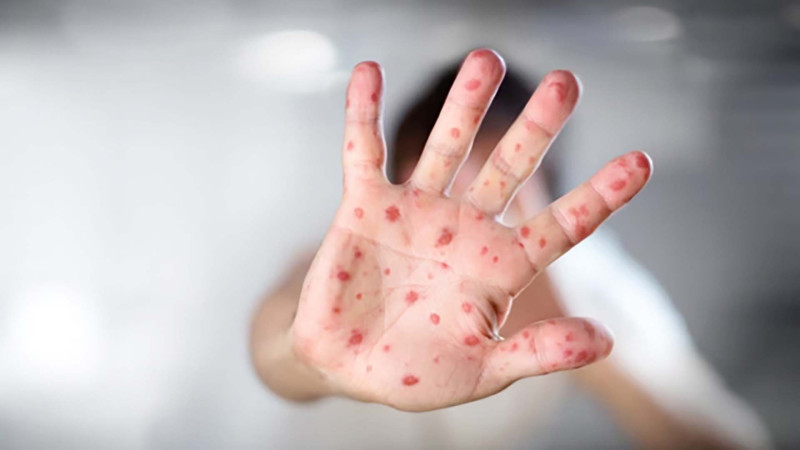 Ölkədə qızılcaya yoluxma halları azalıb