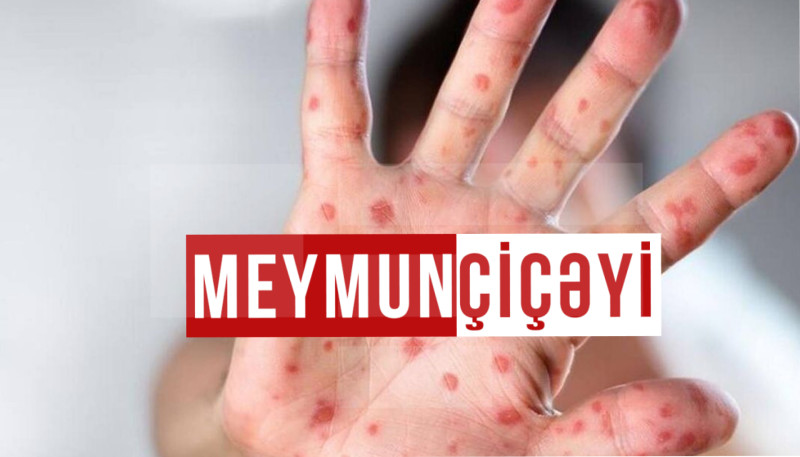 Azərbaycanda meymunçiçəyinin yayılmaması üçün hansı tədbirlər görülür?