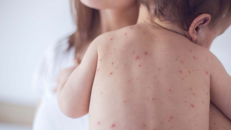 Azərbaycanda qızılca ilə bağlı son vəziyyət necədir? - RƏSMİ