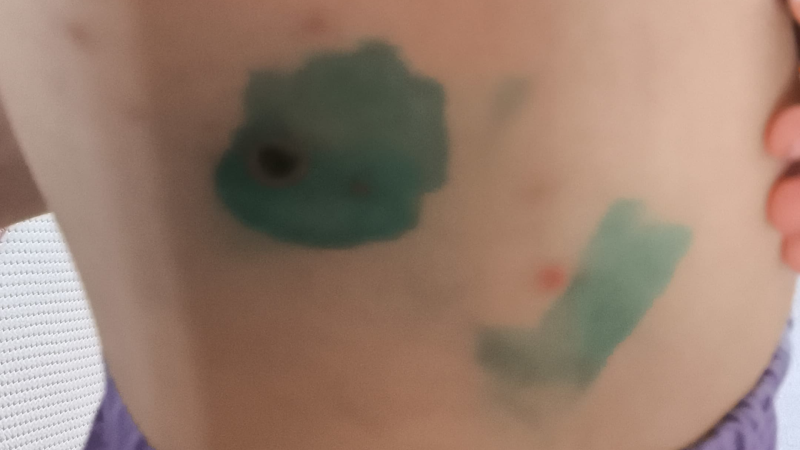 Sumqayıtda qurd basqını azyaşlılarda xəstəlik YARADIB