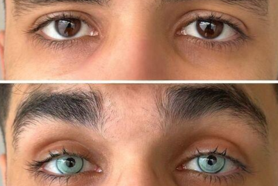 Oftalmoloq: “Göz rəngini dəyişən pasiyent hər şeyi həmin rəngdə görəcək” – AÇIQLAMA