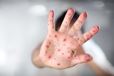 Ölkədə qızılcaya yoluxma halları azalıb