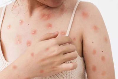 Azərbaycanda meymunçiçəyinə ilk yoluxma