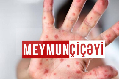 Azərbaycanda meymunçiçəyinin yayılmaması üçün hansı tədbirlər görülür?