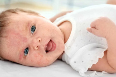 Uşaqlar arasında allergiya yayılır - SƏBƏB